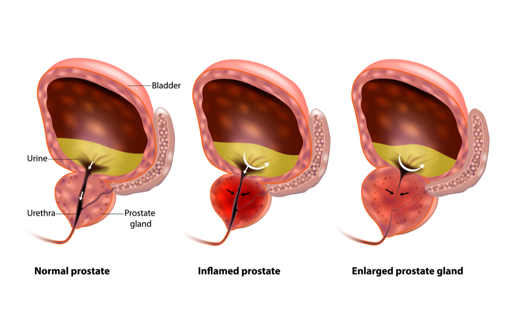 illustration of normal prostate, inflamed prostate, and enlarged prostate