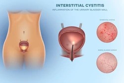 Interstitial Cystitis