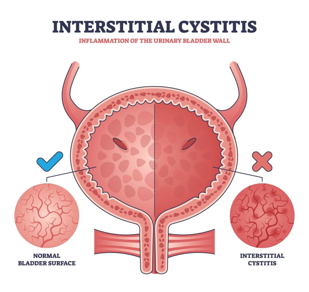 IC Urologists in Orange County CA a diagram demonstrating the basics of interstitial cystitis