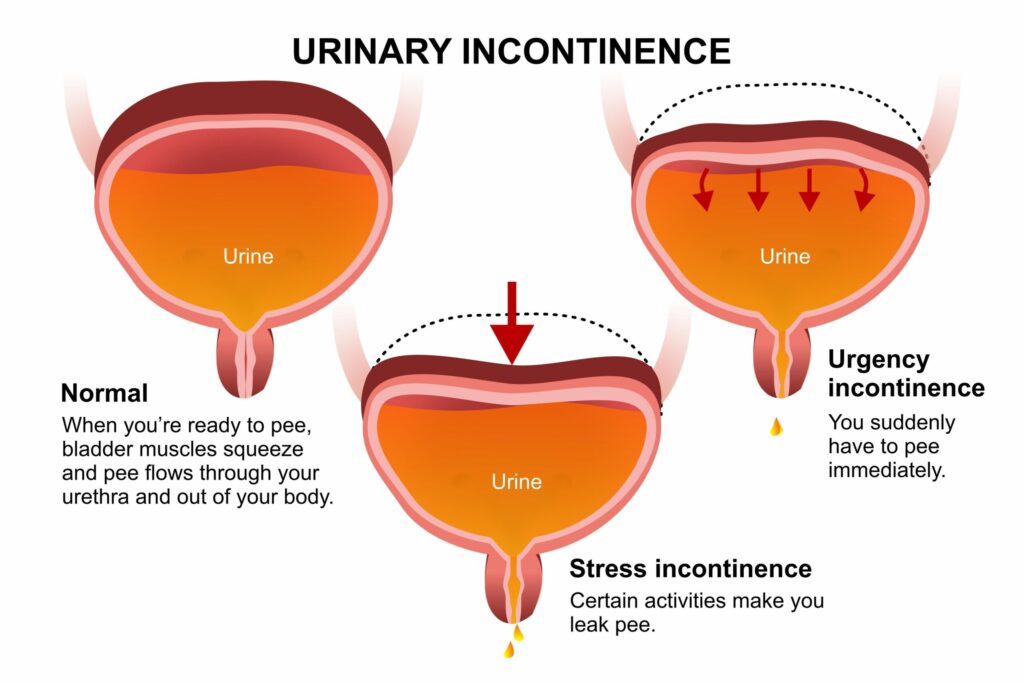 incontinence Urologists in Orange County CA a diagram demonstrating the basics of stress and urge incontinence