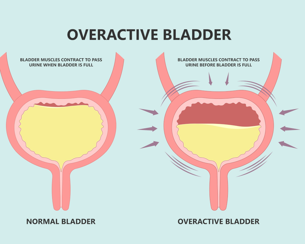 urge pass urine of pelvic floor muscle frequently Bed wetting toilet urination older nerve brain spasm tract tumor cancer stroke stress atonic Benign Lower Often leak anuria Neural Cystitis cord Urologists in Orange County CA a diagram demonstrating the basics of overactive bladder
